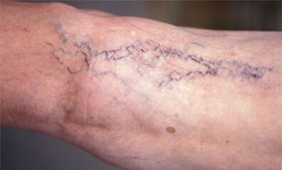 jalgade veenilaiendite ravimeetodid