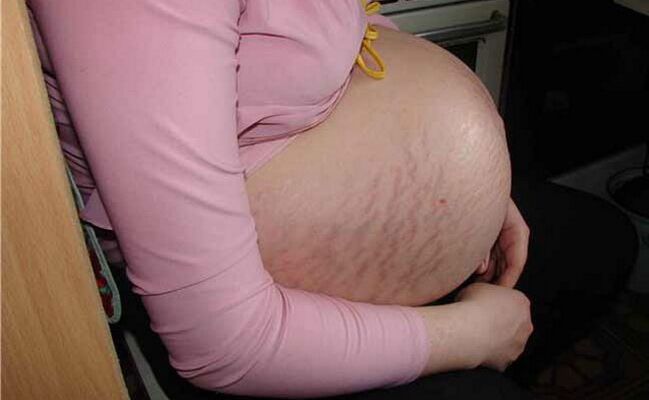 Veenilaiendite põhjused raseduse ajal