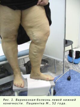 Protsessi peatamiseks tuleb veenilaiendeid ravida