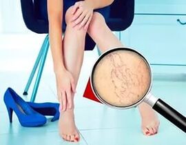 Sümptomid sõltuvad veenilaiendite olemusest ja staadiumist