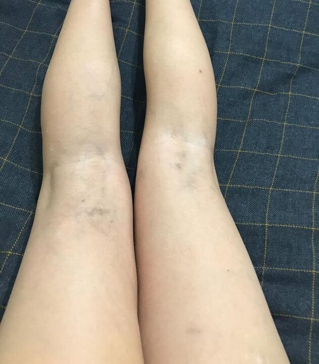 veenilaiendite ilmingud jalgadel